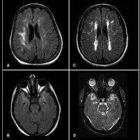 Cerebral Autosomal-Dominant Arteriopathy with Subcortical Infarcts and Leukoencephalopathy - Four Song Demo Session (Demo) (2015)