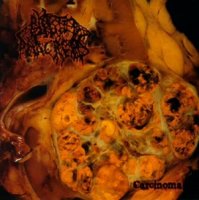 Blasted Pancreas - Carcinoma (2011)