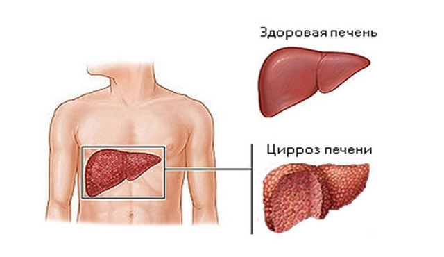 Можно ли вылечить гепатит С при циррозе печени?
